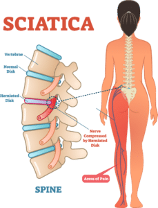 What Can Be Mistaken for Sciatica?