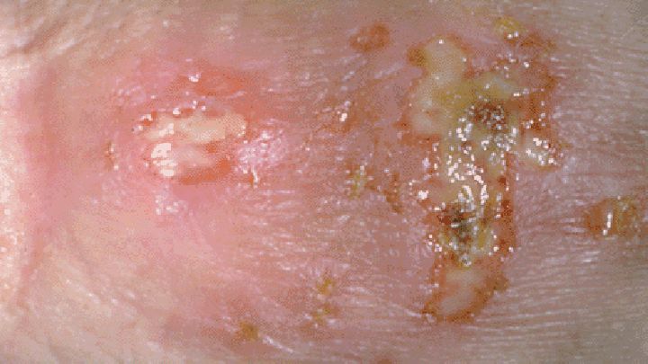 What Can Herpes Be Mistaken for?