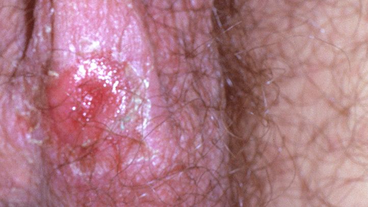 Can Herpes Be Mistaken for Something Else?